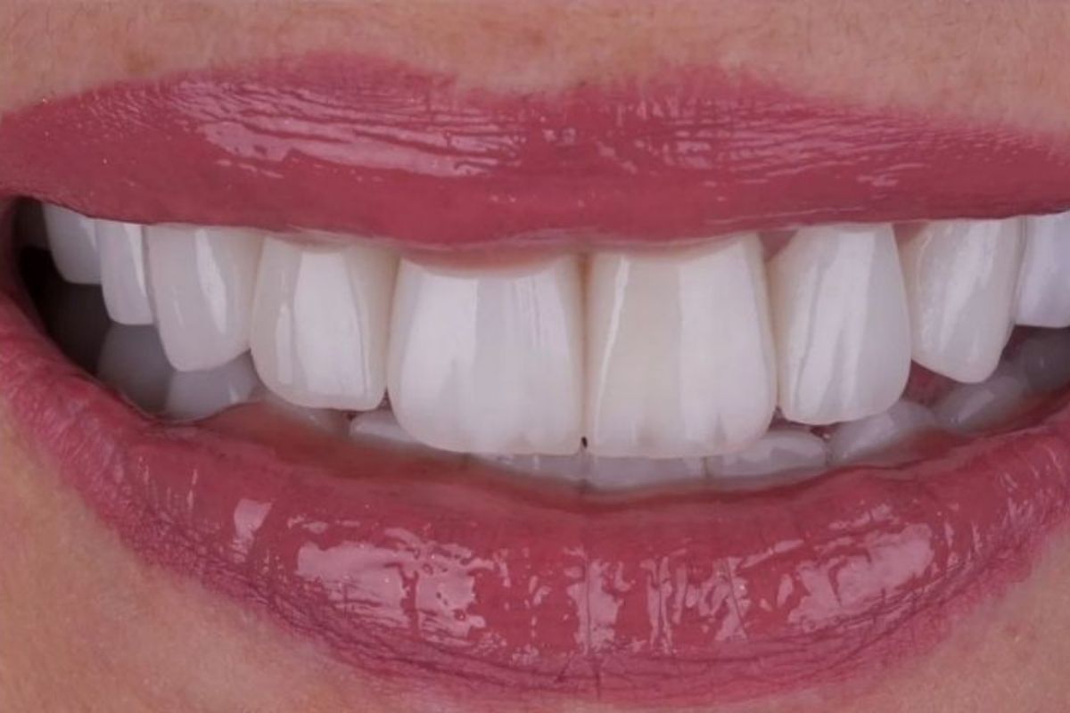 Faseta Laminati