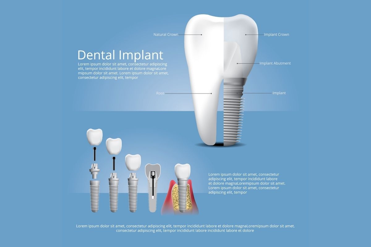 Implantet Dentare